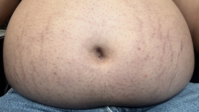 Women who had pregnancy stretch marks: what lotion actually works?
