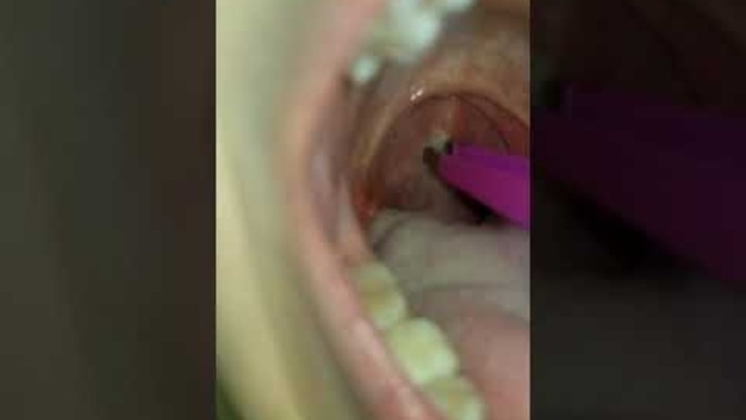 Has this ever happened to you when you got sick or had the flu? Sticky phlegm stuck at the back of your throat?