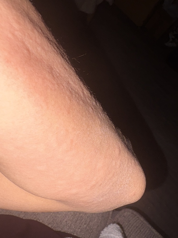 Why did I suddenly get an itchy, bumpy rash on my arms and torso?