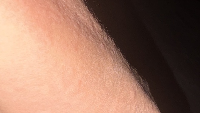 Why did I suddenly get an itchy, bumpy rash on my arms and torso?