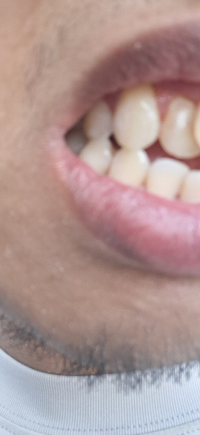 What else can I do to improve my teeth after fillings and stains?