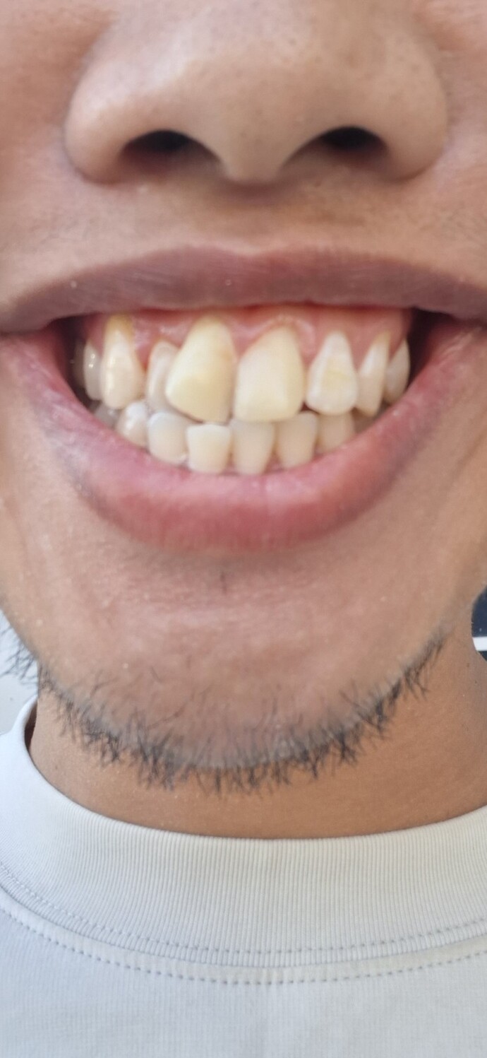 What else can I do to improve my teeth after fillings and stains?