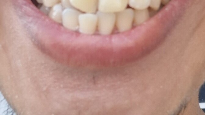 What else can I do to improve my teeth after fillings and stains?
