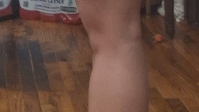 How worried should I be about knee hyperextension and knock knees?