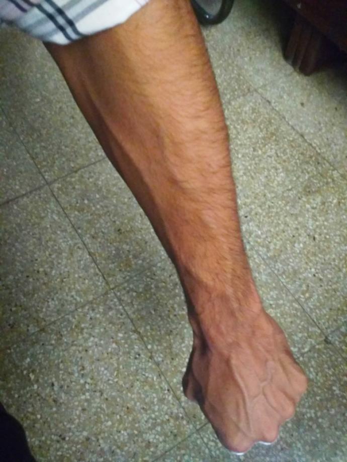 Is it true that people who get angry easily have visible veins on the back of their palms?